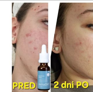 Výsledok jedného ošetrenia kyslikovej terapie 🇩🇰 značky DermaOXY v kombinácii so sérom BALANCING. Ošetrenie vykonané v...