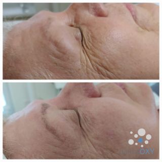 Prišla nám fotka pred a po ošetrení kyslikovej terapie DermaOXY‼️ Na fotke je 70 ročná dáma ktorá bola na ošetrenie v...